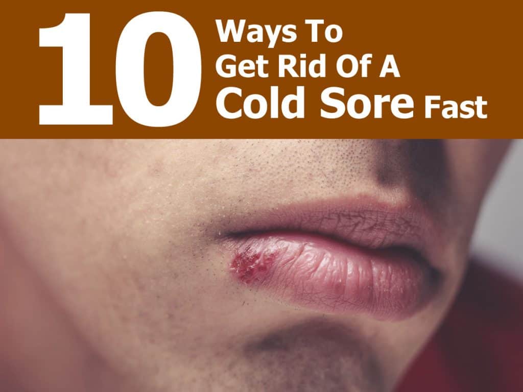 10 ways to get rid of a cold sore fast