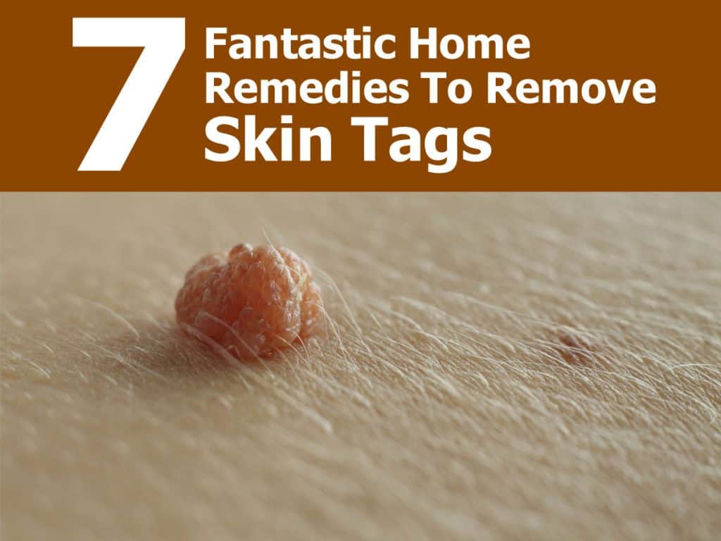7 Fantastic Home Remedies To Remove Skin Tags