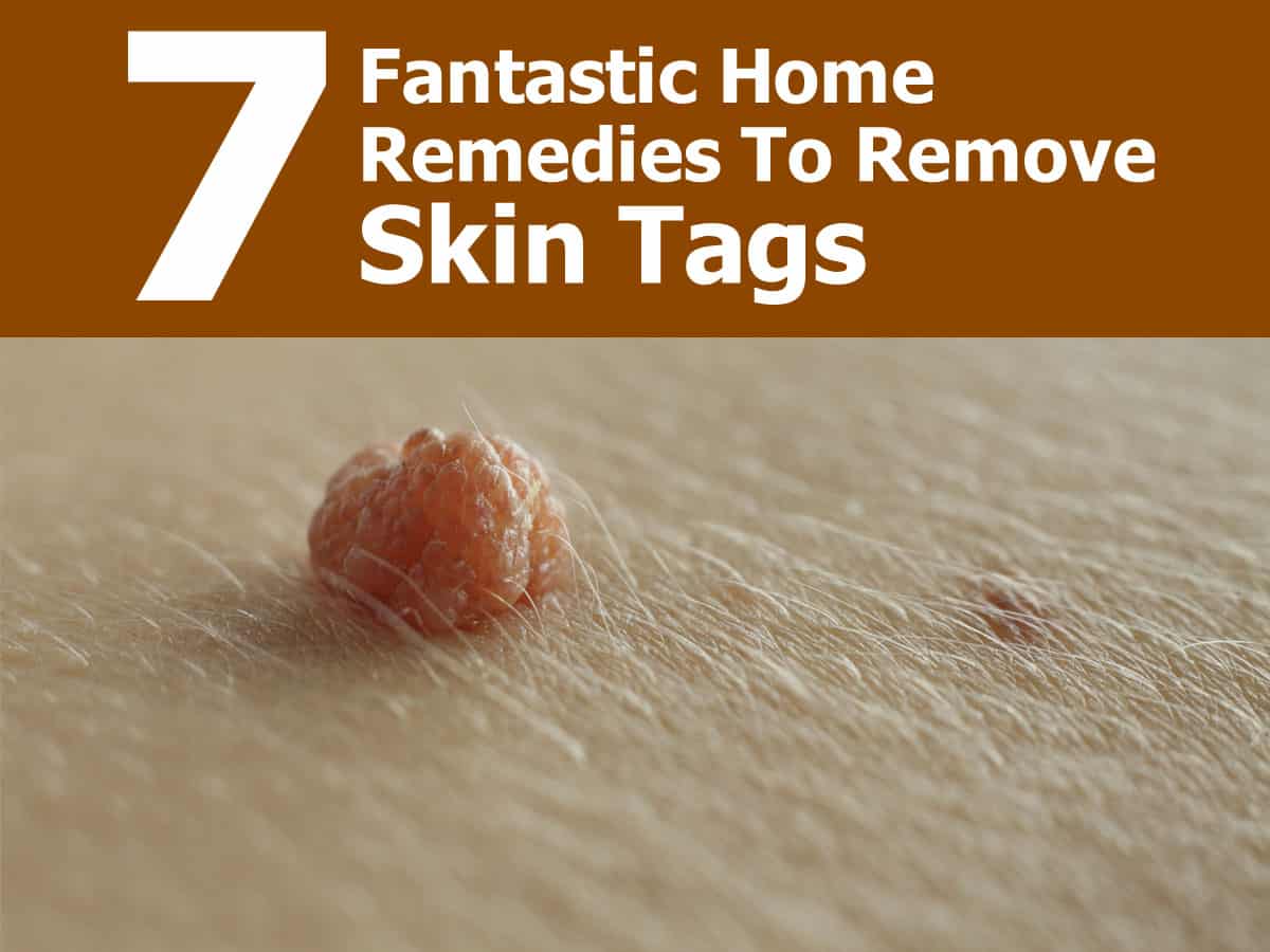How do you get rid of skin tags home remedies 7 Fantastic Home Remedies To Remove Skin Tags