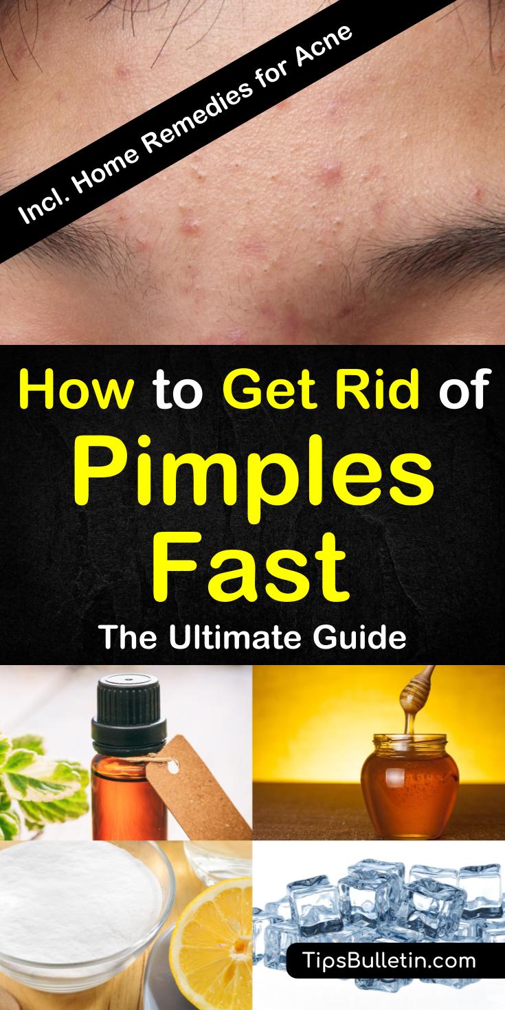 How to get rid of pimples fast with 8+ excellent home remedies - including tips on different types of pimples from under the skin, deep to ingrown. Helps with prevention tips on acne and pimples. The ultimate guide on how to remove pimples #pimples #getridof #skin #acne #remove