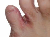 athletes-foot-infection-jungle-rot-1