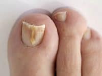 toenail-fungus-1