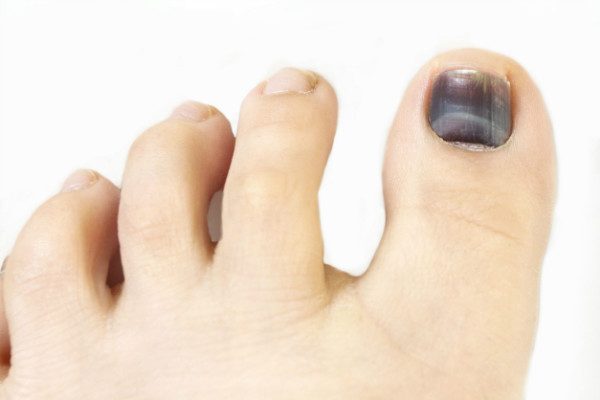 How To Get Rid of Toenail Fungus - 5 Home Remedies
