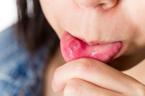 Cold sores and canker sores are two different things.