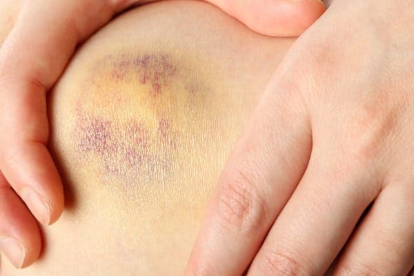 Treating bruises is just one of many witch hazel uses.