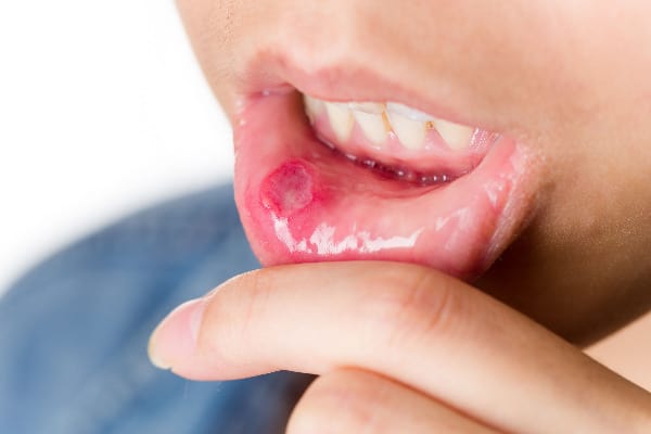 In this article, we're going to go over how to get rid of canker sores.