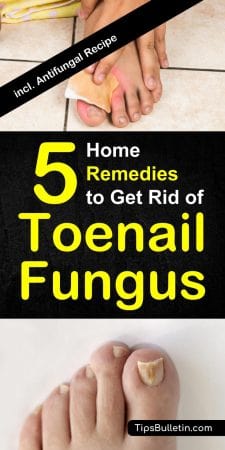 How To Get Rid of Toenail Fungus - 5 Home Remedies