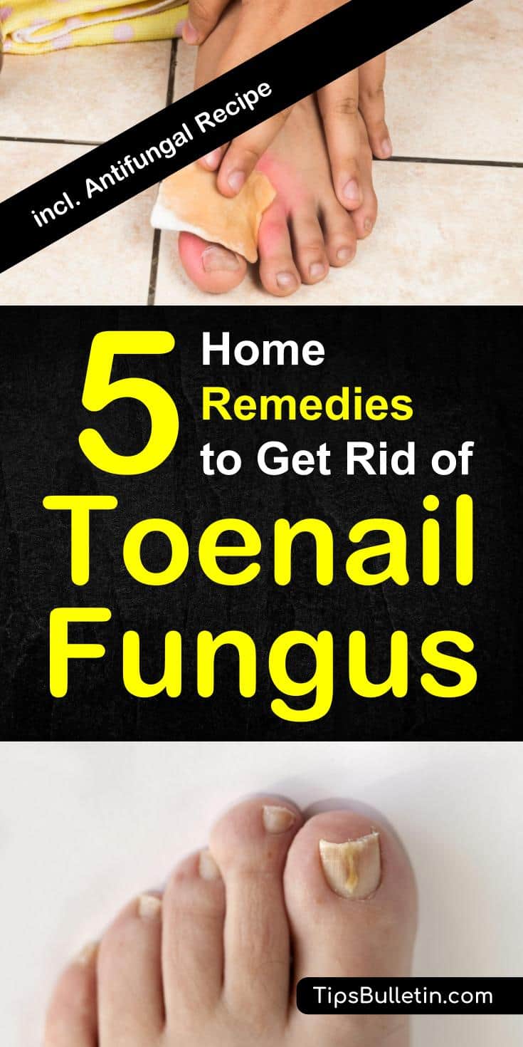 How To Get Rid of Toenail Fungus - 5 Home Remedies includes pictures and tips about remedies to cure toenail fungus fast. Incl. an apple cider vinegar antifungal recipe.#toenailfungus #fungus #remedies