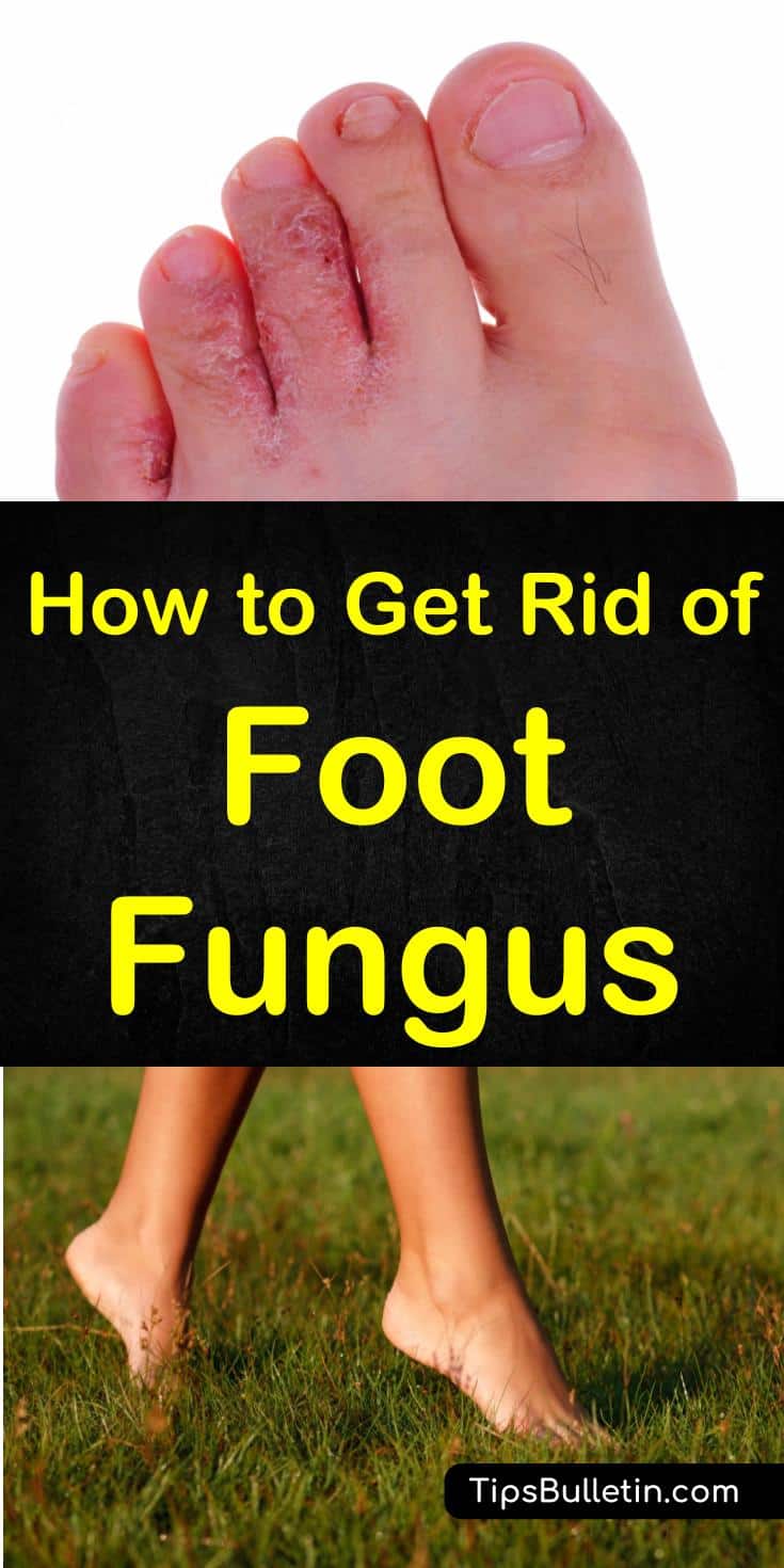 How to Get Rid of Foot Fungus - with pictures of athletes foot and tips on how to use home remedies to get rid of foot fungus fast.#footfungus #athletesfoot