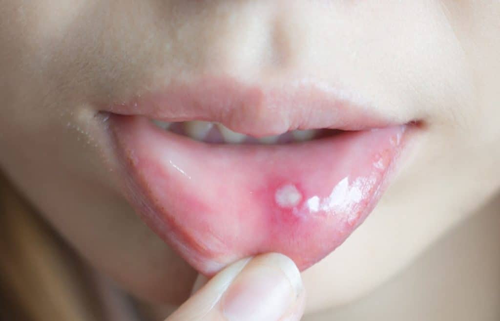 tiny red sores in mouth