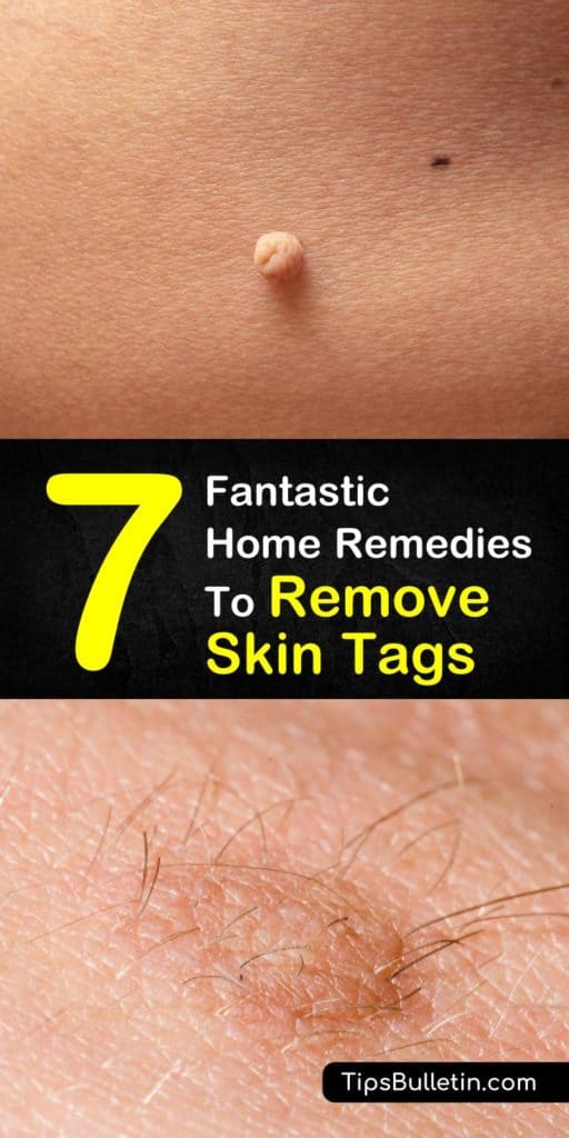 7 Fantastic Home Remedies To Remove Skin Tags - including skin tags removal at home quickly and naturally. Using essential oils, apple cider vinegar, oregano or tea tree oil or various other natural products. Perfect to get rid of skin tags on face, around eyes or under arms. #skintag #removeskintag