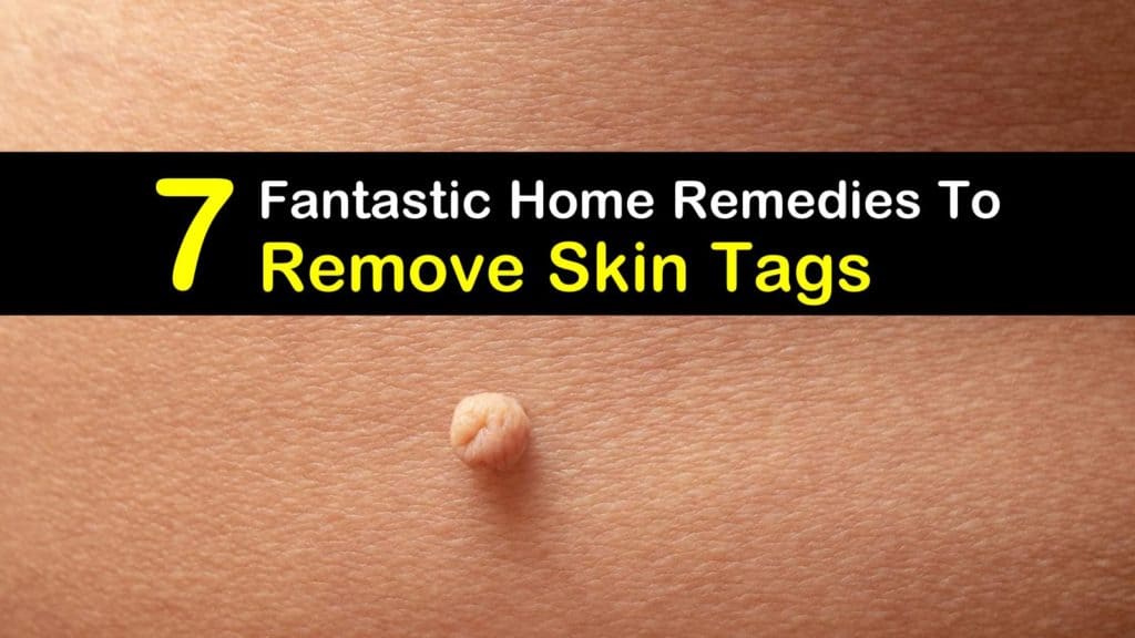 7 Fantastic Home Remedies to Remove Skin Tags