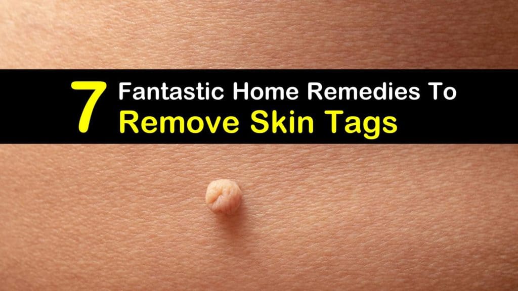 So entfernen Sie Skin-Tags titleimg1