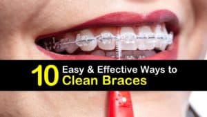 How to Clean Braces titleimg1